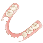 ノンクラスプデンチャーの入れ歯
